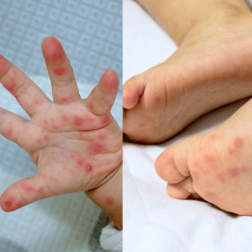 Lee más sobre el artículo Síndrome de Mano, Pie, Boca: Lo que todo padre debe saber